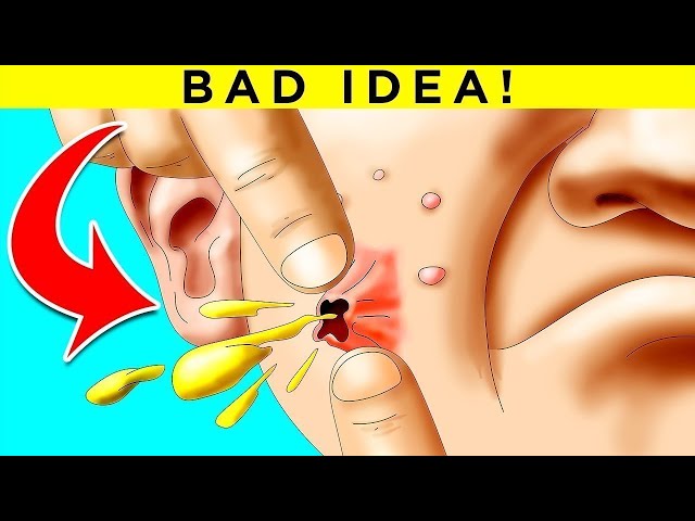 Why Popping Pimples is a Really Bad Idea! Fact Show 19