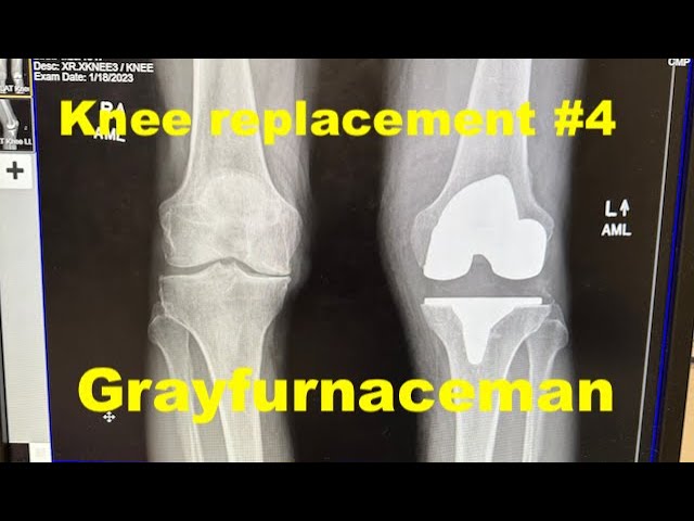 Knee replacement #4