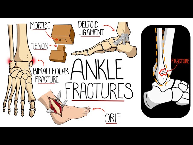 Ankle Fractures Made Easy