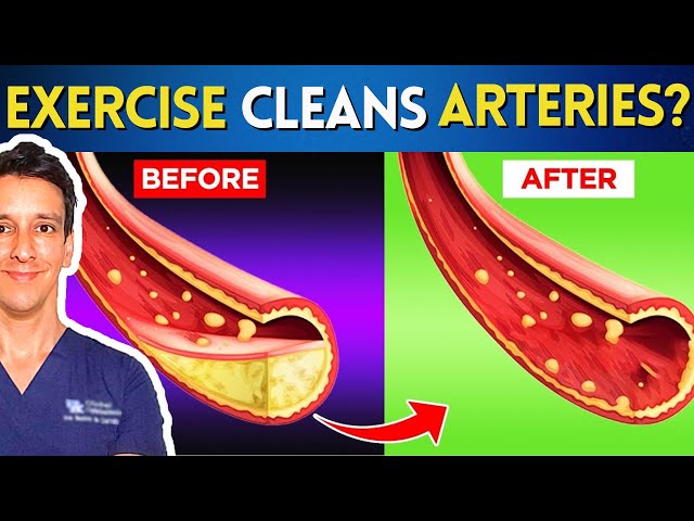 This Exercise shrinks PLAQUE in your arteries (!) | New trial