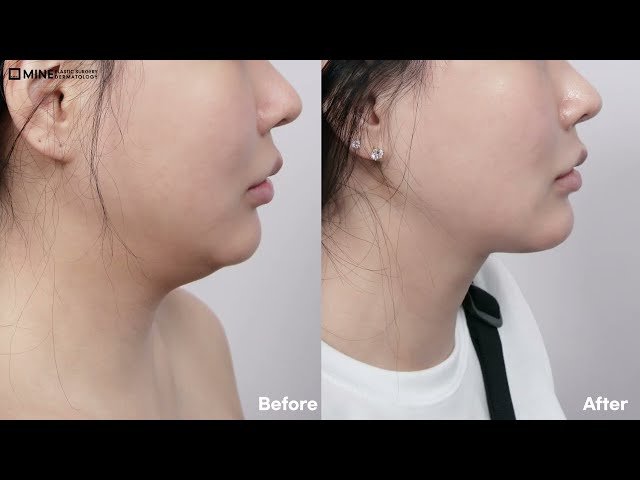 Deep Neck Fat Removal for Double Chins | MINE Plastic Surgery