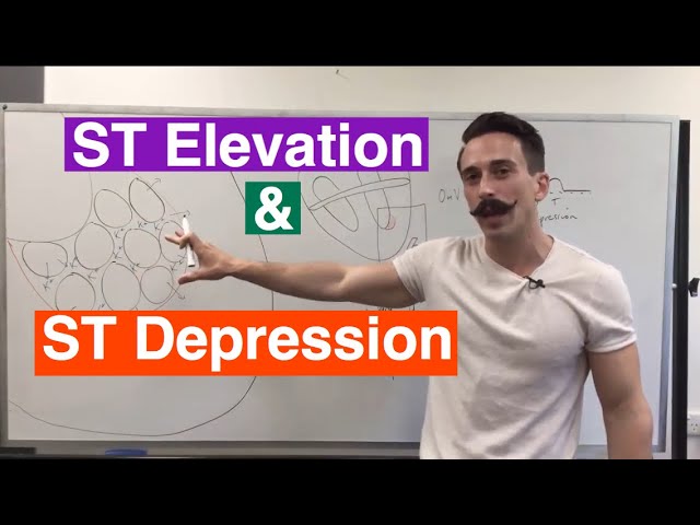 ST Elevation and ST Depression EXPLAINED