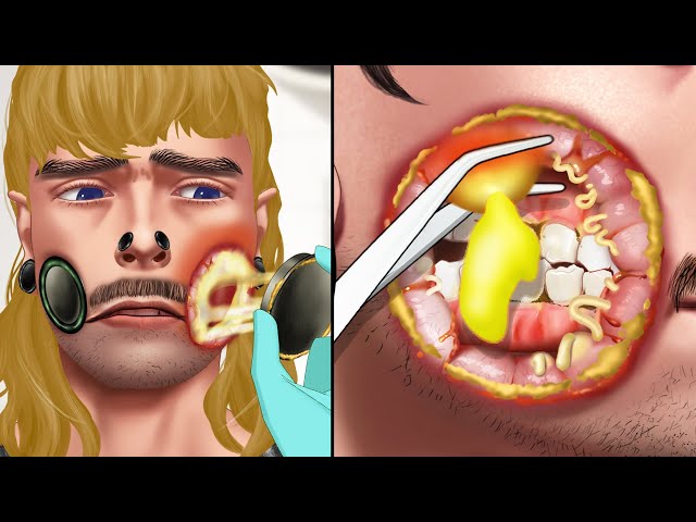 ASMR Cleaning big massive cheek hole gauge blowout on face infected| Body modification