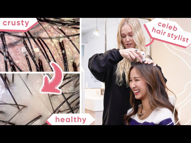 Expert shares WHY you have DANDRUFF & HAIR LOSS 😱 & how to fix it!