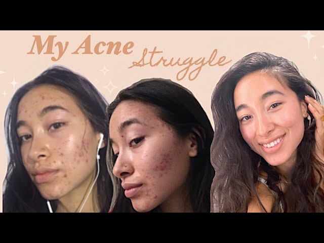 How I Cleared My Skin ( & the inner journey)