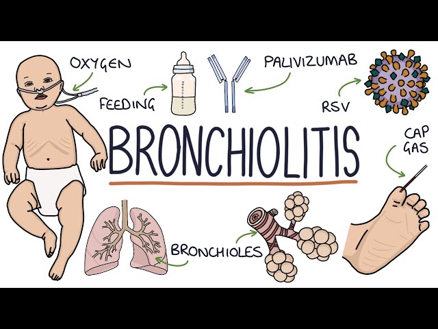 Understanding Bronchiolitis