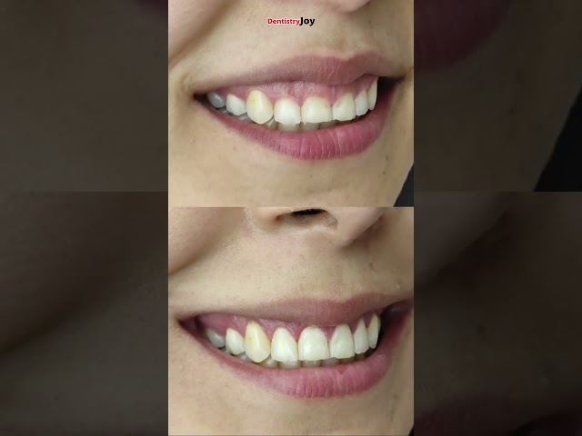 درمان لبخند لثه ای با جراحی نمای قبل و بعد | گامی اسمایل