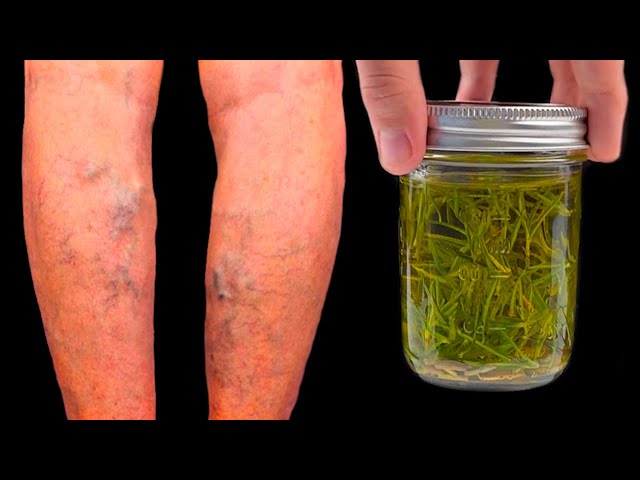 Unbelievable! Varicose veins disappear with rosemary! Treasure that everyone should have in the