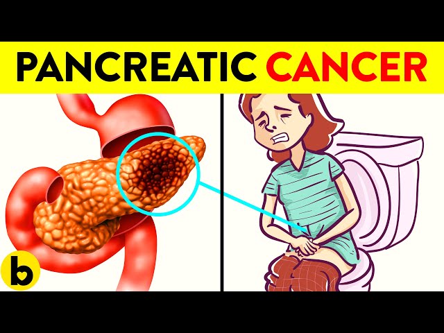 7 Signs Of Pancreatic Cancer You Should Not Ignore