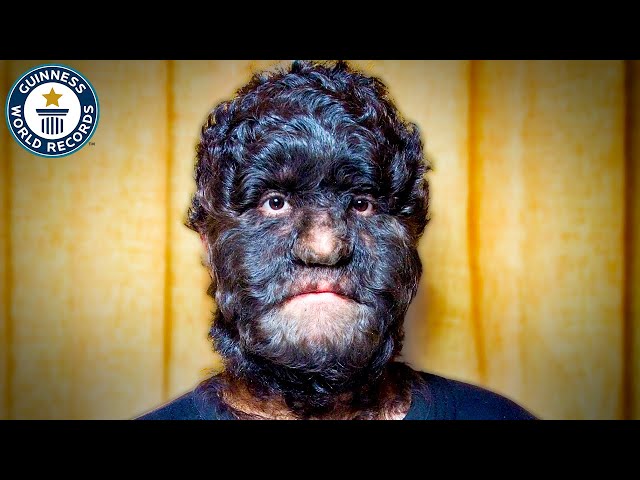 The World's Hairiest Family - Guinness World Records