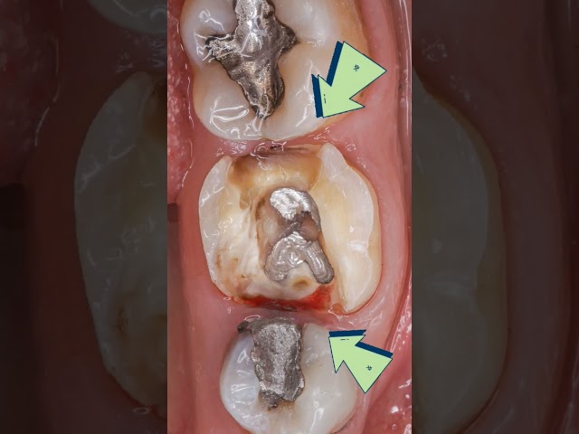 بازسازی دندان با اورلی سرامیکی